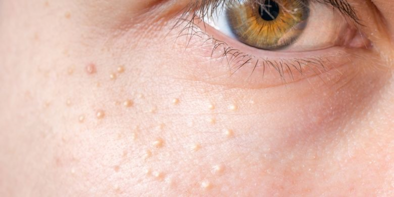 7 Bahan Skincare Untuk Menghilangkan Milia