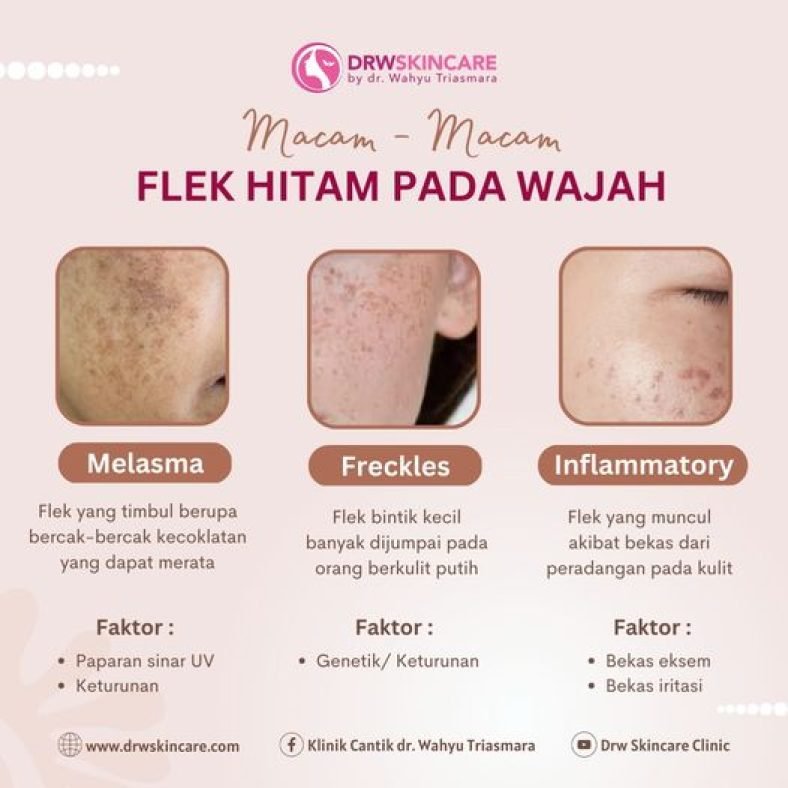 Macam – Macam Flek Hitam Pada Wajah