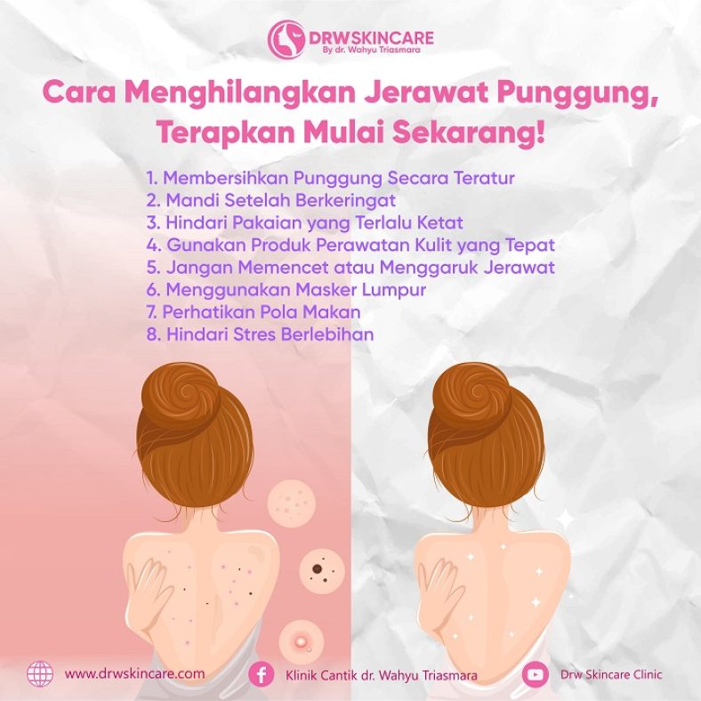 Begini Cara Menghilangkan Jerawat Punggung, Terapkan Mulai Sekarang!