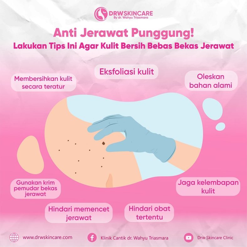 Anti Jerawat Punggung! Lakukan Tips Ini Agar Kulit Bersih Bebas Bekas Jerawat