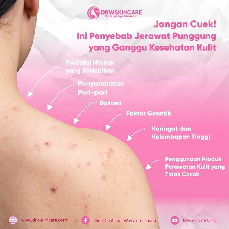 Jangan Cuek! Ini Penyebab Jerawat Punggung yang Ganggu Kesehatan Kulit