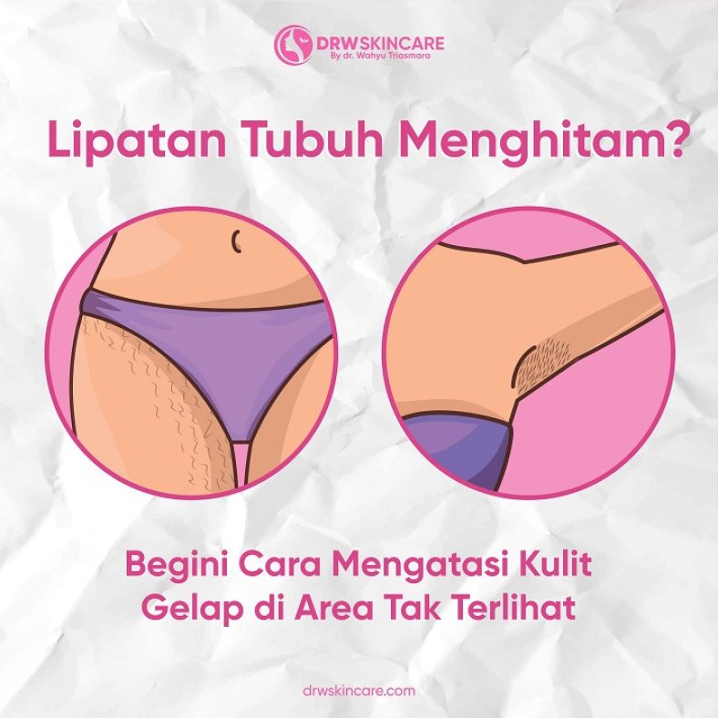 Lipatan Tubuh Menghitam? Begini Cara Mengatasi Kulit Gelap di Area Tak Terlihat