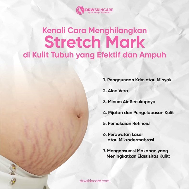Kenali Cara Menghilangkan Stretch Mark di Kulit Tubuh yang Efektif dan Ampuh