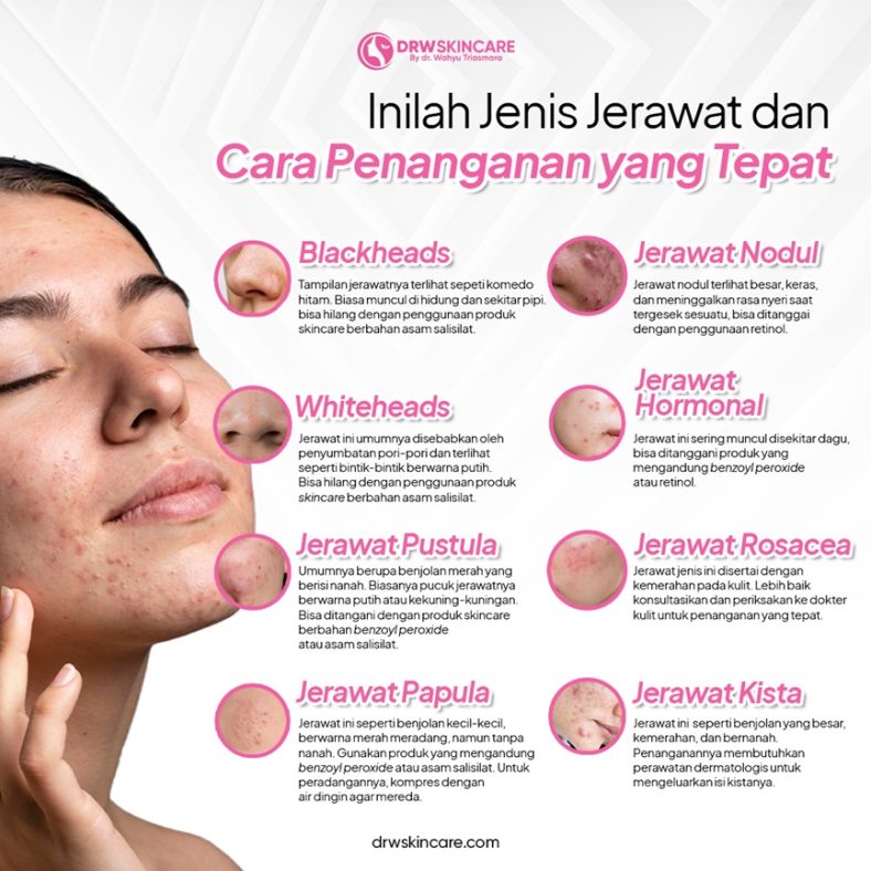 Inilah Jenis Jerawat dan Cara Penanganan yang Tepat